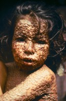 Бангладеш - Девочка  больная натуральной оспой